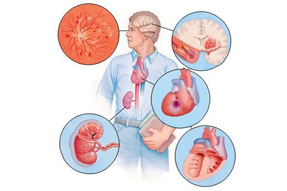 Oštećenje raznih organa s dugotrajnom arterijskom hipertenzijom